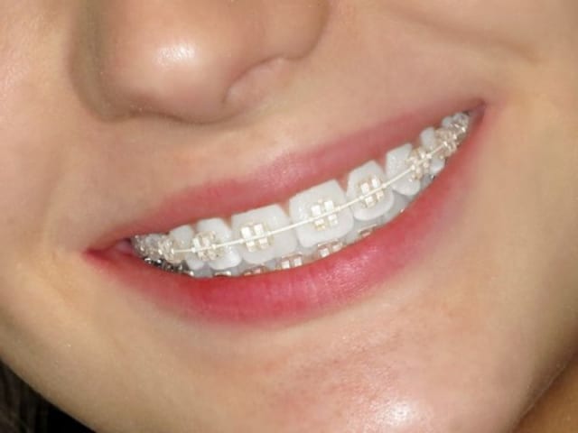 Niềng răng mắc cài sứ được sử dụng chất liệu sứ cao cấp, có khả năng chịu lực gấp 5 lần so với răng thật