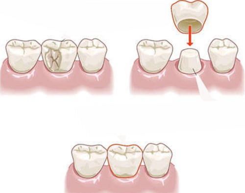 Để bảo vệ răng sau khi lấy tủy, bác sĩ khuyên bạn nên bọc sứ thẩm mỹ