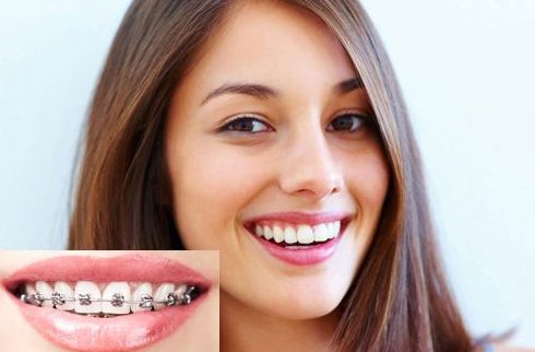 Niềng răng được xem là giải pháp chỉnh hình răng hoàn hảo với khí cụ là mắc cài và khay niềng
