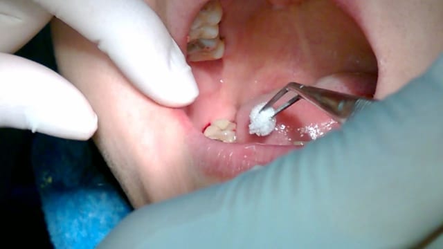 Khi thấy con bị sâu răng hàm mẹ nên đưa con tới nha khoa để thăm khám luôn tìm phương pháp điều trị hợp lý nhất
