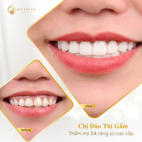 Thực hiện 24 chiếc răng sứ thẩm mỹ tại Jun Dental giúp nụ cười của chị Gấm trở nên tươi sáng và tràn đầy sức sống hơn