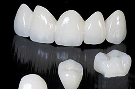 Răng sứ nguyên chất được kết cấu hoàn toàn bằng sứ đảm bảo độ bền cao, giống y như răng thật đem lại sự tự nhiên nhất
