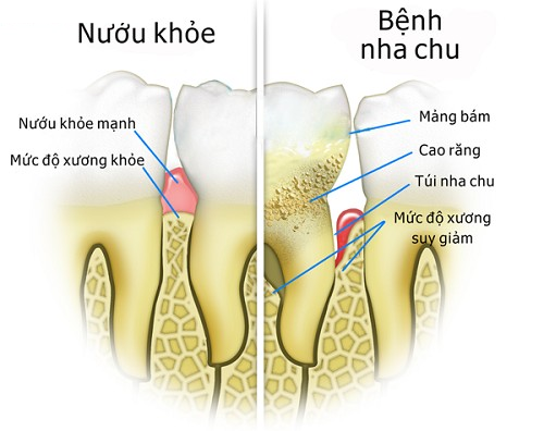 Những ảnh hưởng khi không nhổ răng số 8 sớm