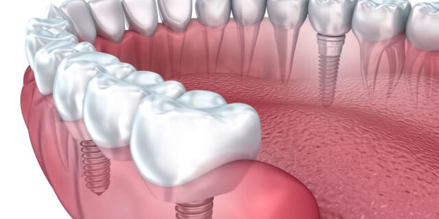 Ưu điểm nổi bật của cấy ghép răng Implant là gì?