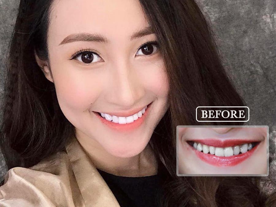 Điều trị hàn trám răng sâu tại Jun Dental