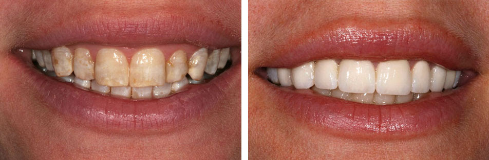  Bọc răng sứ là phương pháp tốt nhất giúp khắc phục bệnh thiểu sản men răng 