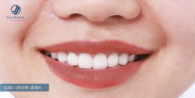 Mặt dán sứ Minish Laminate chỉ dày khoảng 0,3 – 0,6 mm, hoàn toàn không cần mài răng, không gây xâm lấn đến mô răng thật