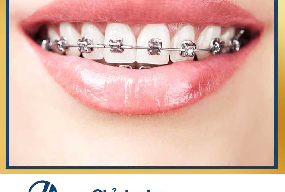 Niềng răng mắc cài kim loại có nguy hiểm gì tới sức khỏe không?
