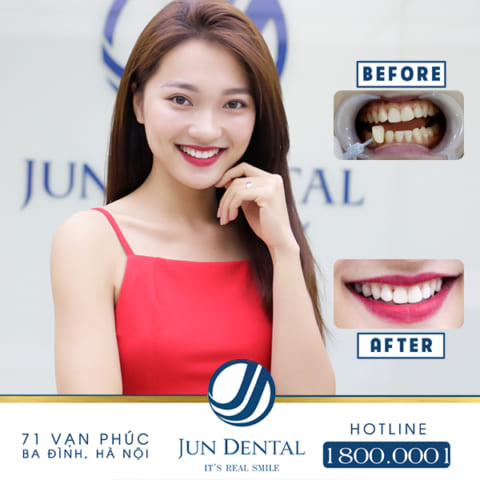 Nha khoa quốc tế JunDental là một trong những địa chỉ dán sứ siêu mỏng không mài răng uy tín tại Hà Nội