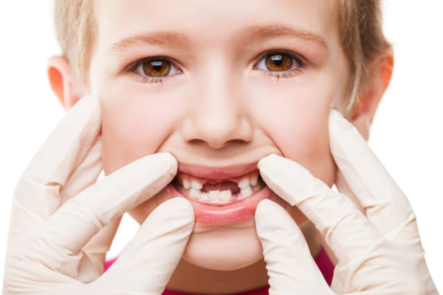 Vecni fluor được xem là tấm chắn cho lớp men răng bên ngoài tránh được sự tác động của vi khuẩn