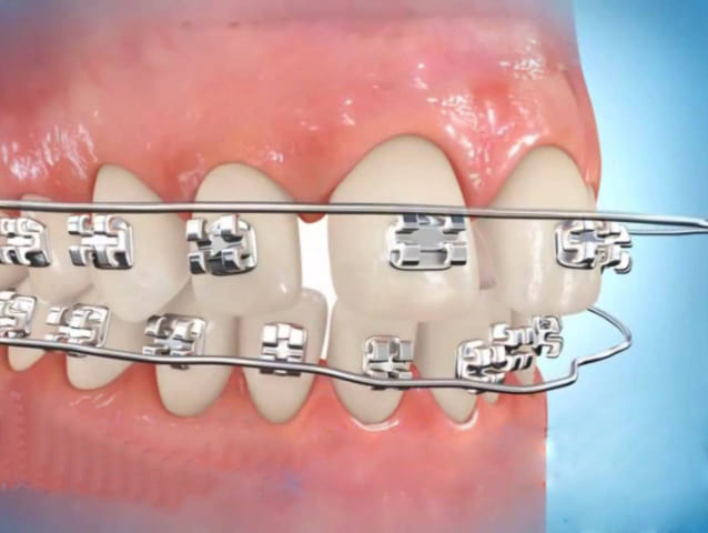 Thời gian niềng răng còn phụ thuộc vào tình trạng răng và độ tuổi của mỗi người