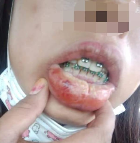 Sau một tuần niềng răng cô gái thấy môi mình bị sưng và đi khám nhận được chẩn đoán bị viêm môi do niềng răng
