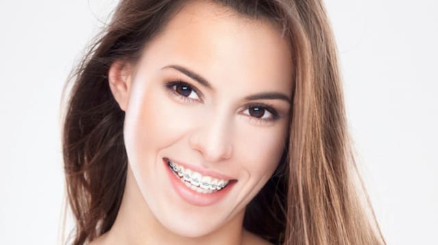 Niềng răng tuổi 30 là kĩ thuật phù hợp nhất để khắc phục mọi khuyết điểm của răng