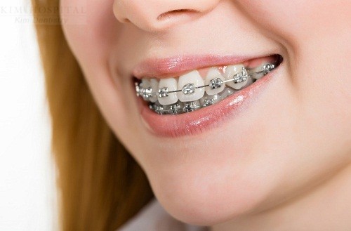 Đánh lún răng cửa sẽ hỗ trợ quá trình niềng răng được diễn ra thuận lợi và nhanh chóng hơn