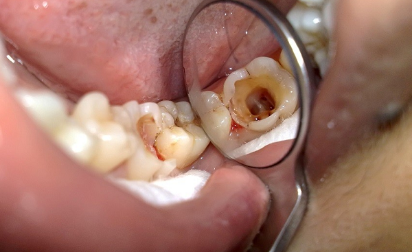 Bật mí cách khắc phục chức năng ăn nhai khi răng hàm bị vỡ