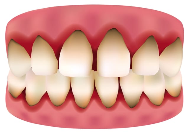 Khi thấy răng có sự thay đổi màu sắc răng cần tới ngay trung tâm nha khoa thăm khám để được điều trị kịp thời