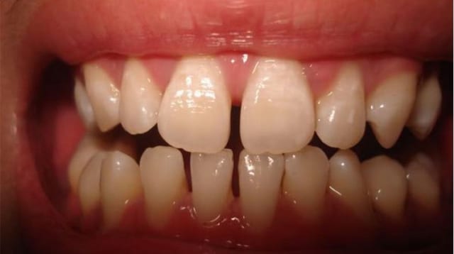 Răng thưa là tình trạng răng có khe hở ở giữa các răng  và thường xảy ra khi có hiện tượng di răng hoặc răng quá nhỏ so với cung hàm