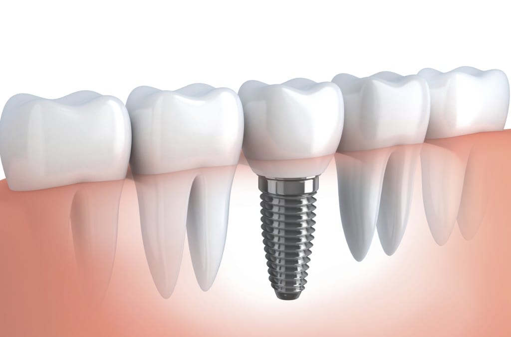 Những lưu ý khi trồng răng implant
