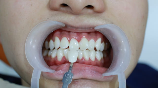 Quy trình tẩy trắng răng phải được thực hiện nghiêm chỉnh và đúng liều lượng thuốc tẩy trắng, thời gian tẩy trắng thẩm mỹ nhằm mang lại kết quả như ý vẫn đảm bảo tính an toàn cho mọi khách hàng