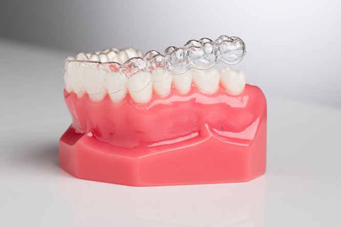 Chuyên gia nói gì về kĩ thuật niềng răng trong suốt Invisalign