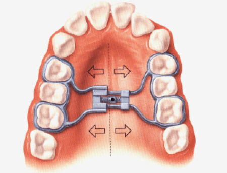 Nong hàm là bước hỗ trợ cho quá trình niềng răng được diễn ra thuận lợi hơn