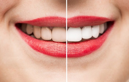 Tẩy trắng răng sẽ giúp loại bỏ những màu vàng ố trên răng hiệu quả, cho hàm răng luôn trắng sáng đều màu