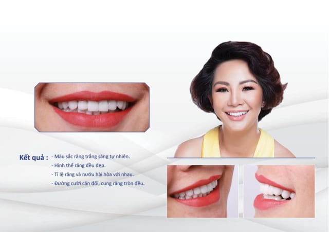 Sau khi làm răng sứ thẩm mỹ giúp chị Hiền trở nên tự tin hơn mỗi khi giao tiếp với khách hàng