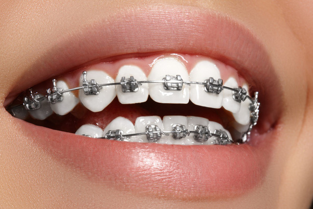 Niềng răng cho người bị hô nướu có hiệu quả không?