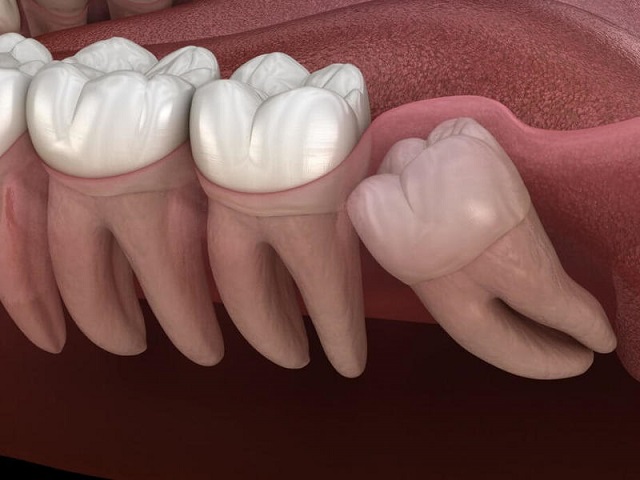 Răng khôn mọc ngầm có thể gây viêm lợi