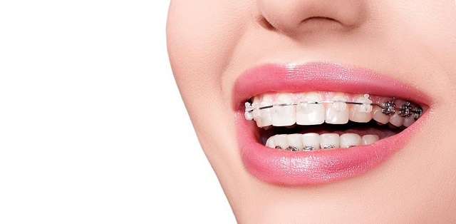 Người bị các bệnh lý răng miệng có niềng răng được không