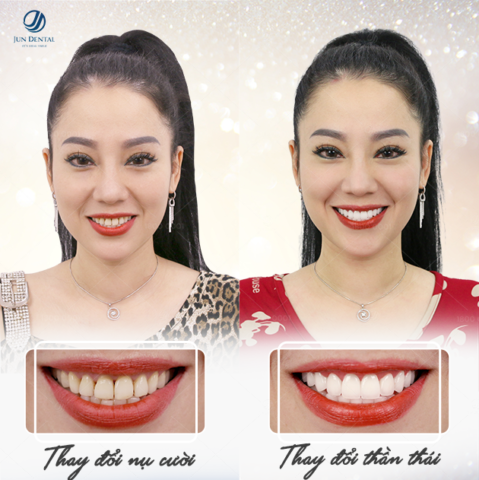 Minh Phương thay đổi nụ cười với công nghệ làm răng sứ thẩm mỹ tại Jun Dental