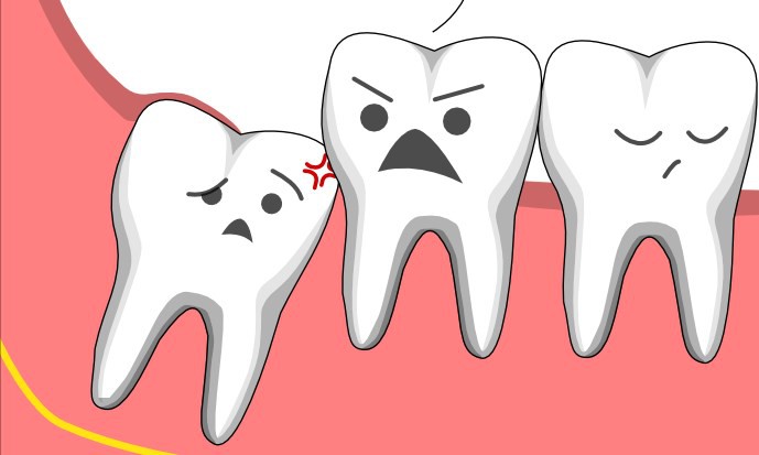Răng khôn mọc lệch có ảnh hưởng gì không?