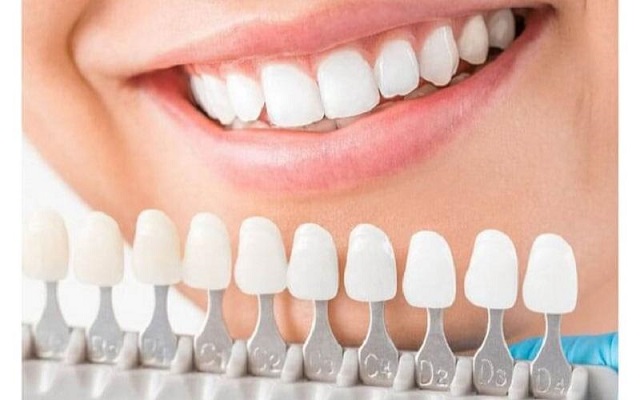 Ưu điểm răng sứ nguyên chất là gì?