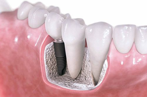 Công nghệ Implant One Day – Trông Răng Implant Trong Ngày