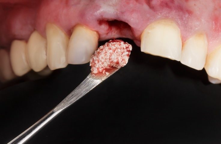 Ghép xương để trồng răng implant mất thời gian bao lâu