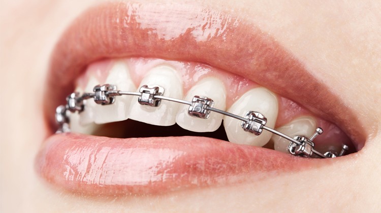 Chỉnh nha mắc cài 3M kim loại có phải bỏ răng thật?