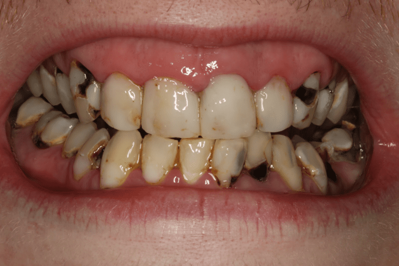 Chữa sâu răng tại nhà hiệu quả