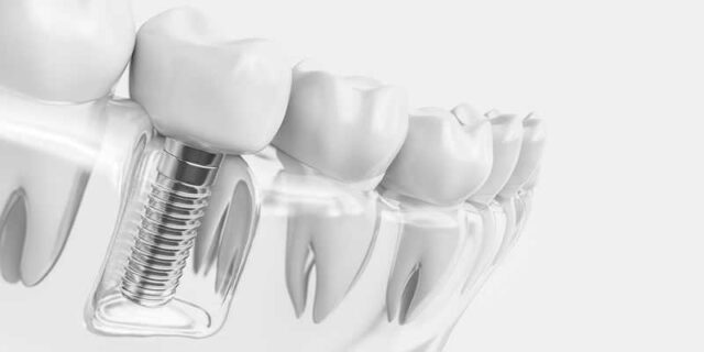 Cấy ghép implant - Giải pháp phục hồi răng miệng hiệu quả