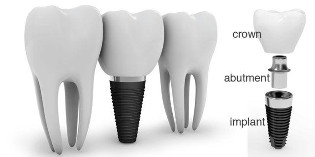 Giá của răng sứ trồng trên trụ Implant