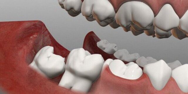 So sánh mức độ đau khi nhổ răng khôn hàm trên và hàm dưới