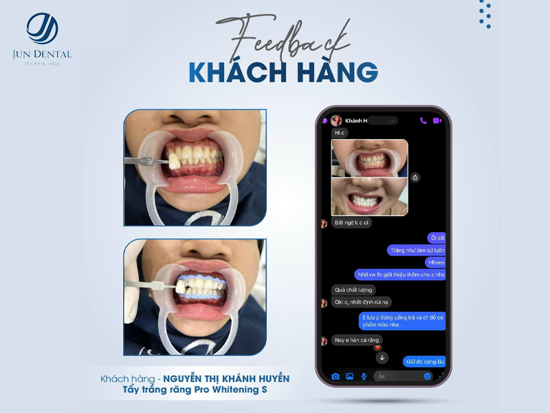 Tẩy trắng răng Pro Whitening S – chị Nguyễn Thị Khánh Huyền tại Jun Dental