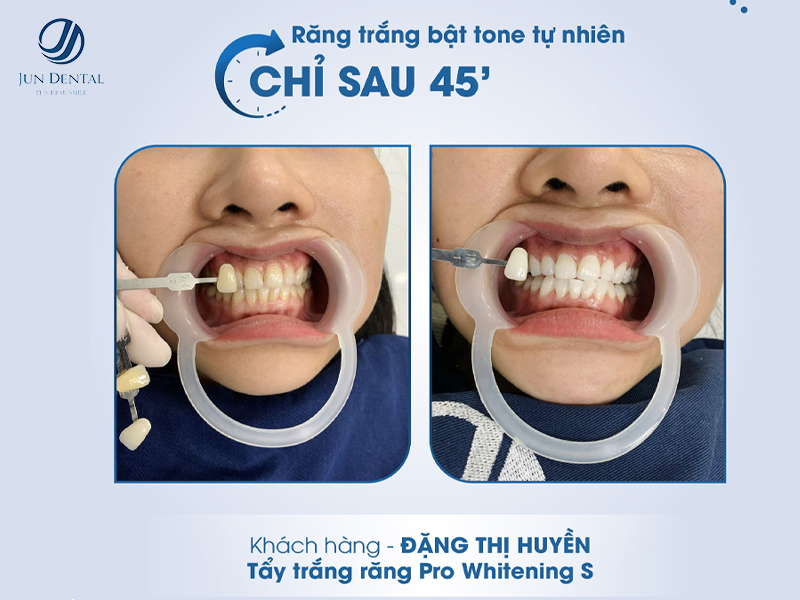 Tẩy trắng răng Pro Whitening – khách hàng Đặng Thị Huyền tại Jun Dental